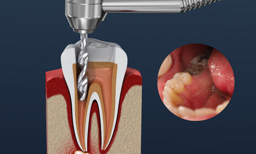 Root Canal Therapy in Udumalpet
