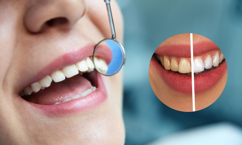 Teeth Scaling in Udumalpet