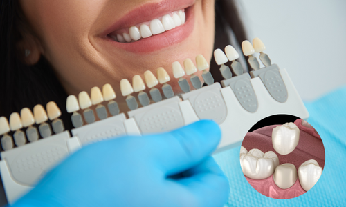 Dental Crown in Udumalpet